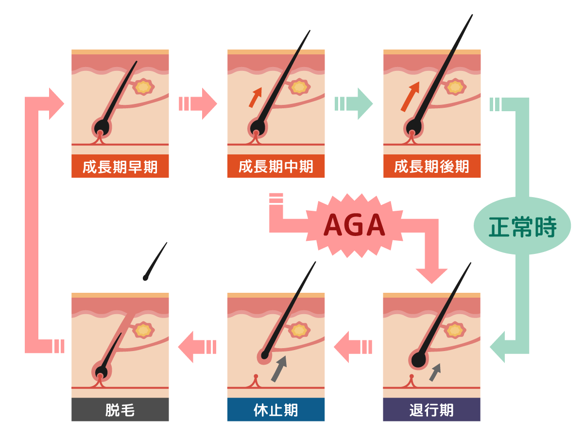AGAによるヘアサイクルの乱れを示す図